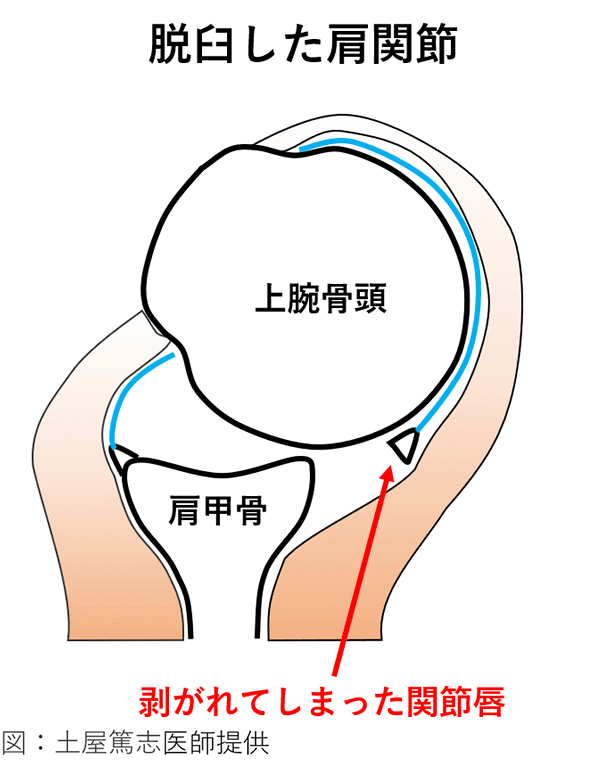 関節唇断裂手術から明かされる大谷翔平の復帰プラン